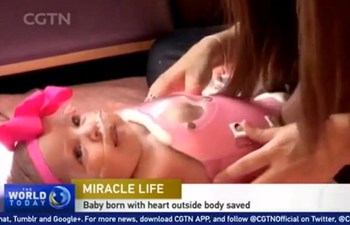 Baby born with heart outside body survives surgery